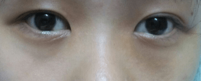 戒色14天黑眼圈淡化？学生党护眼法下载戒色